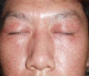 ����������Ƥ��֢״,����������Ƥ��