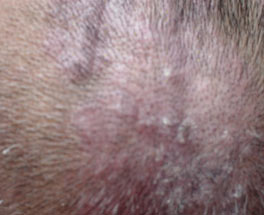 ֬����Ƥ�׵����Ʒ����Ƕ���