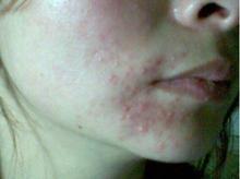 专家出招治疗皮肤过敏