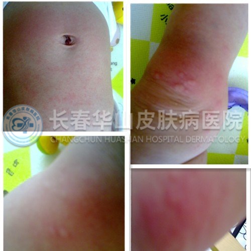 皮肤严重过敏 乱吃药不可取