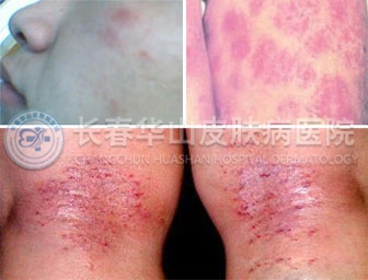 ������Ƥ�׵�����